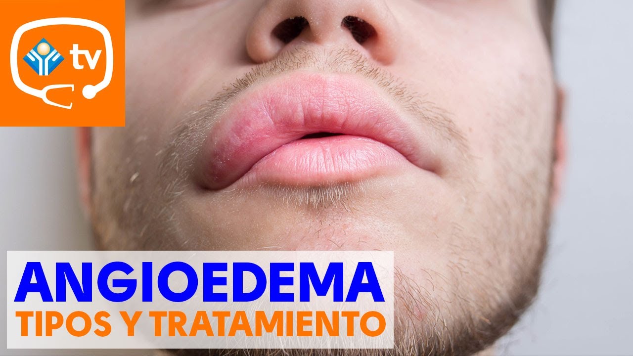 hinchazon repentina de labios dela boca