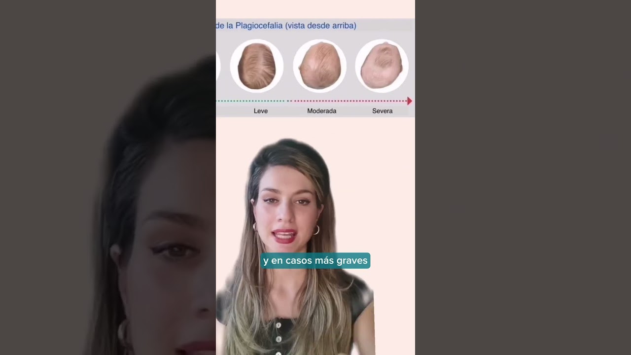 plagiocefalia en niño de 2 años