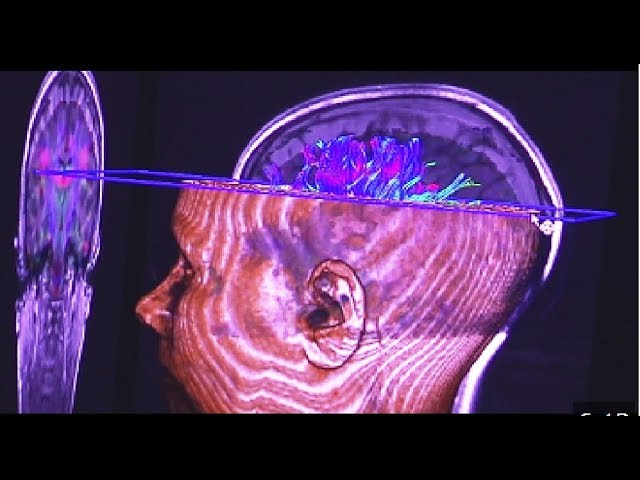 areas del cerebro afectadas por la esquizofrenia