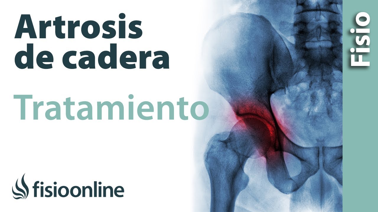 displasia de cadera en adultos tratamiento fisioterapeutico