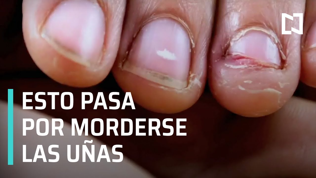 fotos de personas que se muerden las uñas
