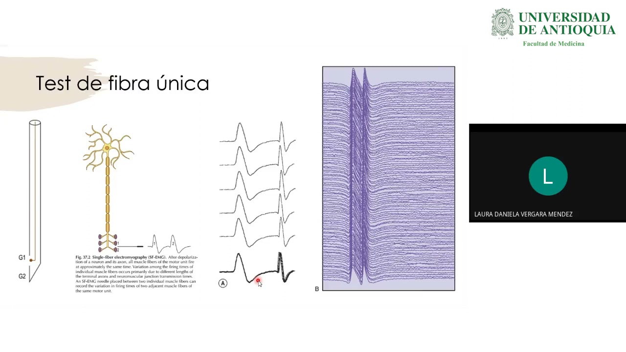 enfermedades de la union neuromuscular