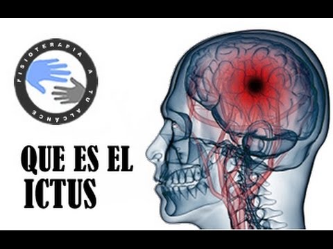 es lo mismo ictus que infarto cerebral