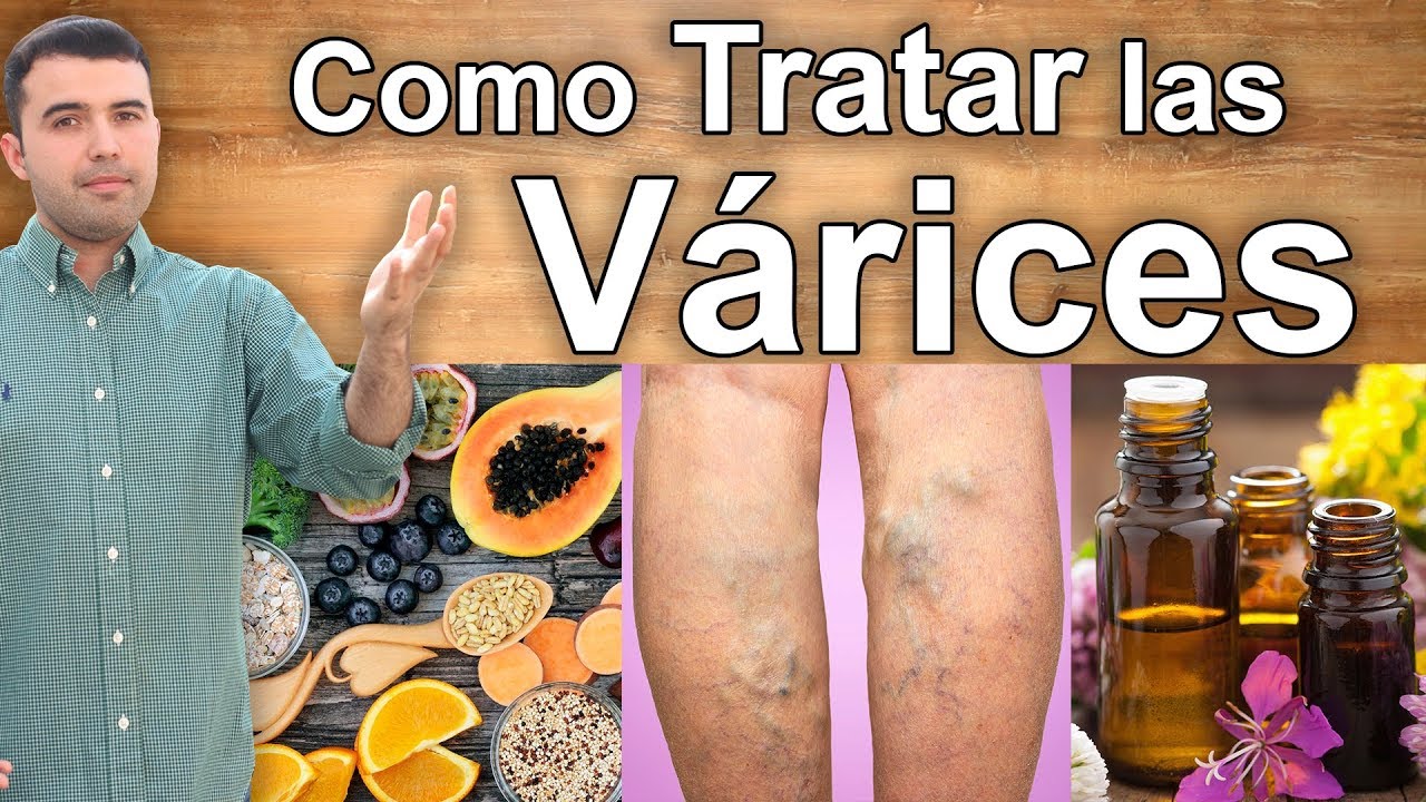 hierbas naturales para curar las varices