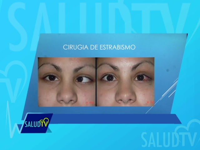ictus cerebral que afecta a la vista