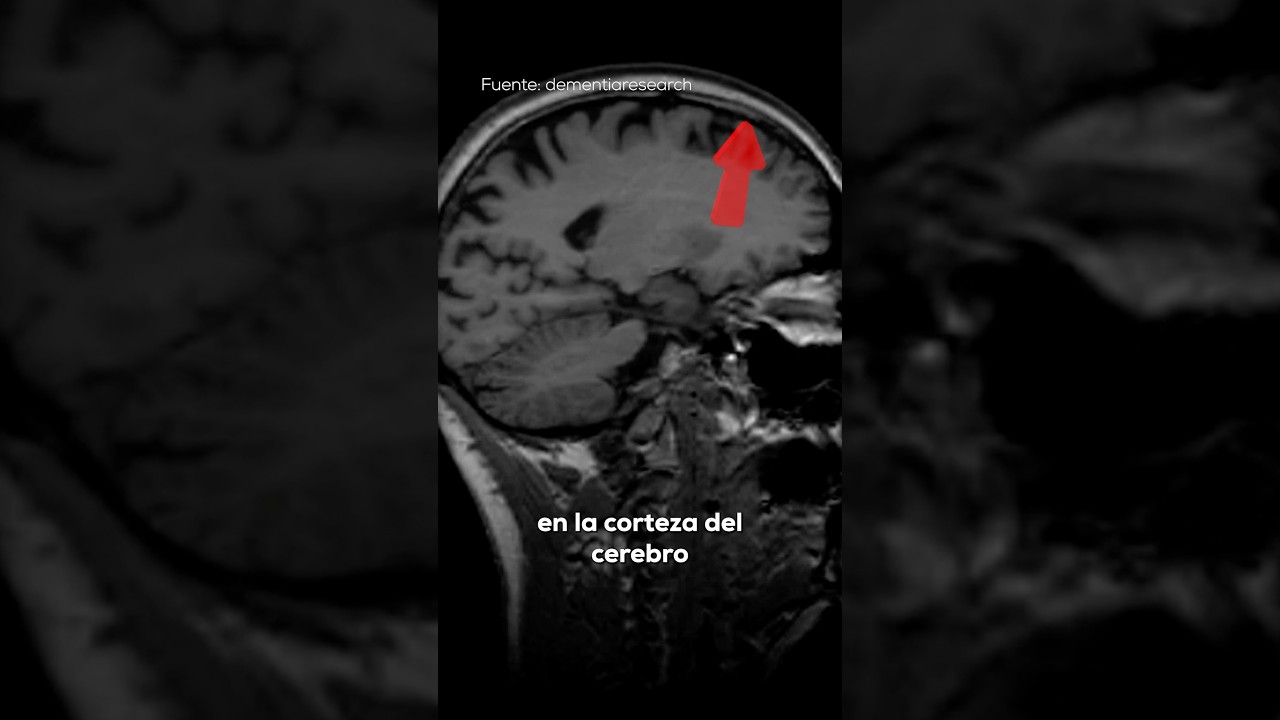 cuáles son los síntomas de la atrofia cerebral
